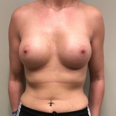 After image 1 Case #86846 - Submuscular Breast Augmentation with Soft Touch Round Cohesive Silicone Implants