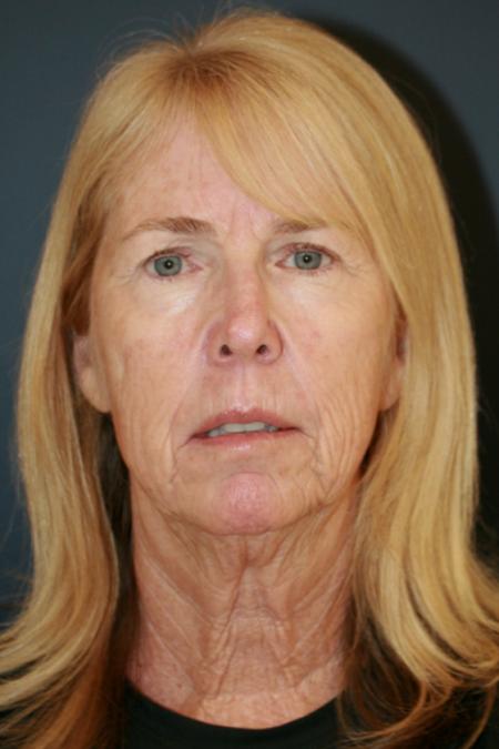 Before image 1 Case #111621 - Female Comprehensive Facial Rejuvenation