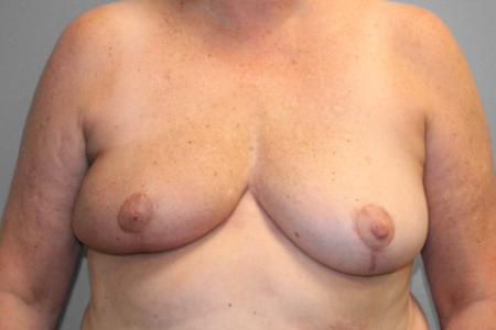 After image 1 Case #107816 - Breast Reconstruction